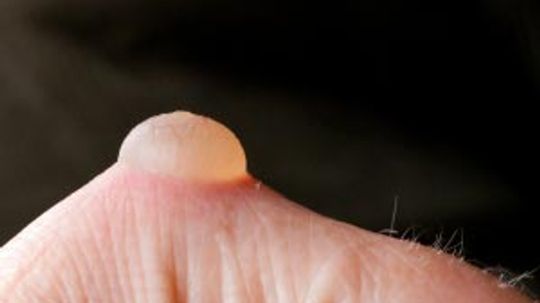 Is it safe to lance a blister?