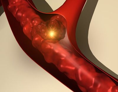 blood clot in arteries