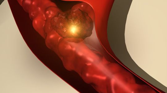 What is laser clot busting?