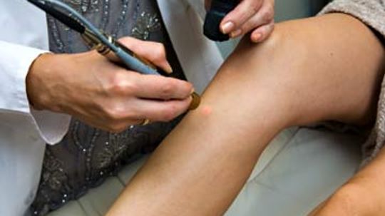 How much does laser hair removal cost?