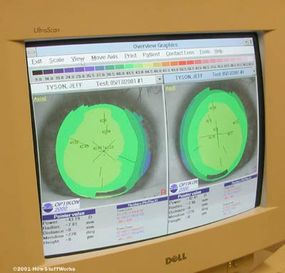 The monitor connected to the topographer shows a color map of my corneas.