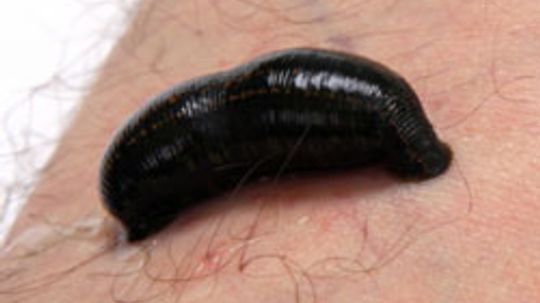 Are leeches being used in modern medicine?