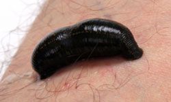 leech attached to human leg