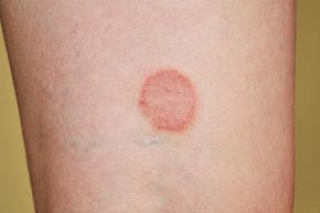 lichen ruber planus on the leg of young woman