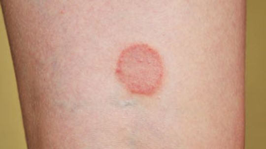 Lichen Planus Overview