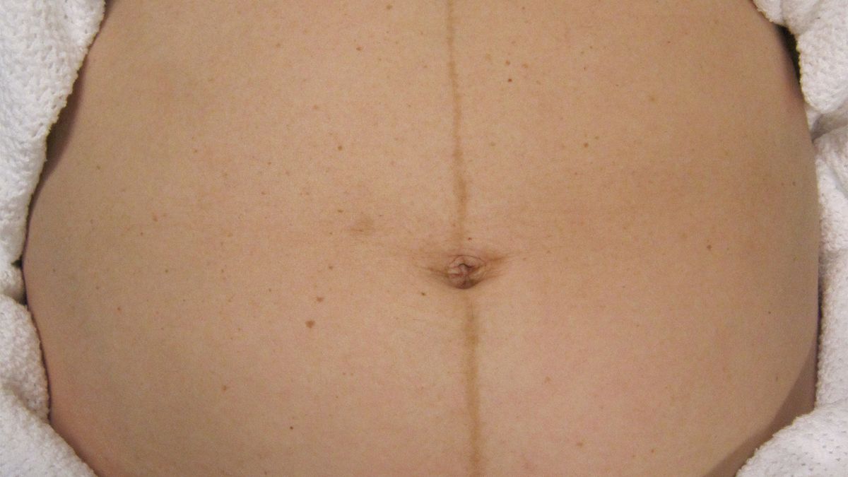 растяжки на груди во время беременности фото фото 90