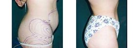 Liposuction &quot;before and after&quot; photos