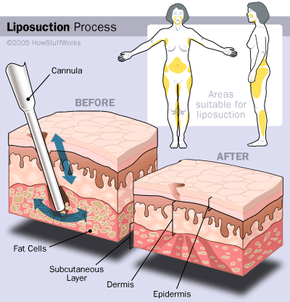 does liposuction 