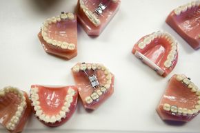 Theme parks recover lots of dentures after roller coaster rides. Most go unclaimed.