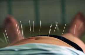 Acupuncture can relieve pain.