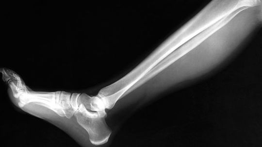 5 Most Commonly Broken Bones