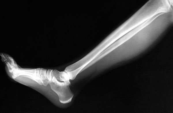 How do broken bones heal? HowStuffWorks