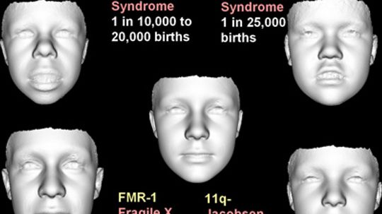 Does the shape of my face show that I have a genetic disorder?