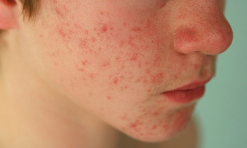 Fact or Fiction: Pimples