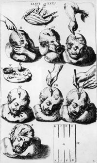 A circa 1600 instructional illustration for trepanning a skull. See more pictures of the brain.