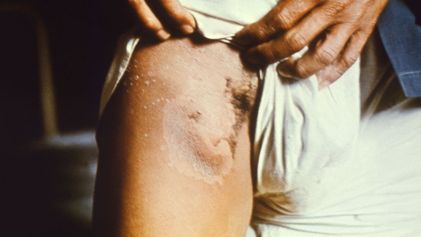 person with bubonic plague on thigh