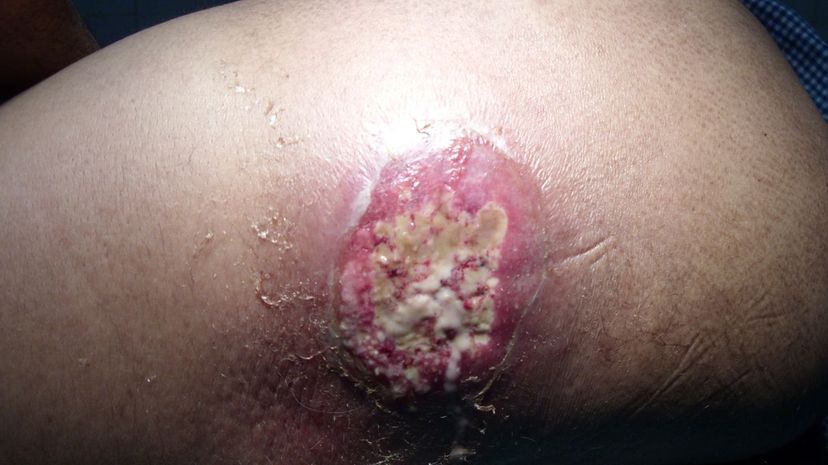 Question 19 - Carbuncle