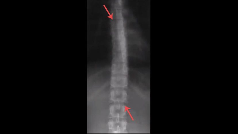 Thoracic vertebrae