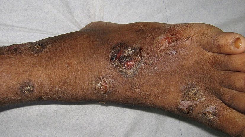 Question 27 - Impetigo