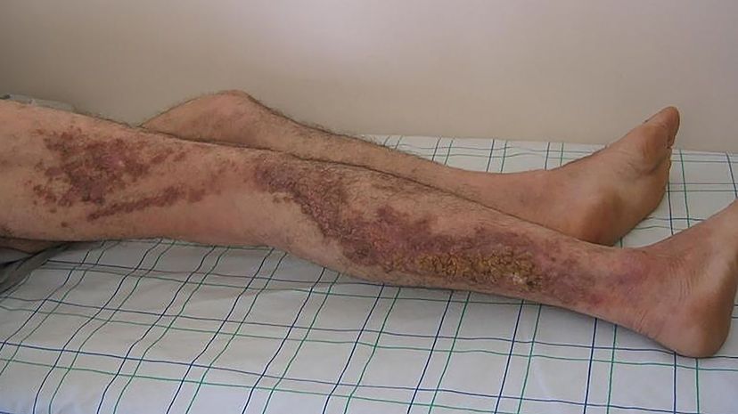 Question 28 - Darier's disease