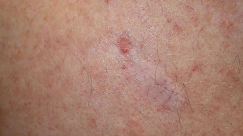 Question 23 - Basal cell carcinoma