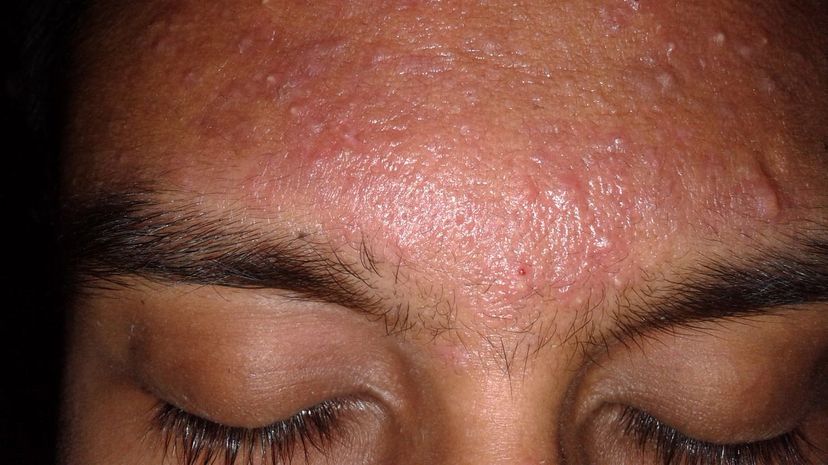 Question 2 - Acne