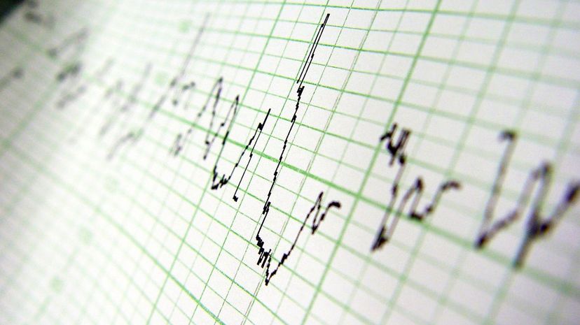 Myocardial infarction