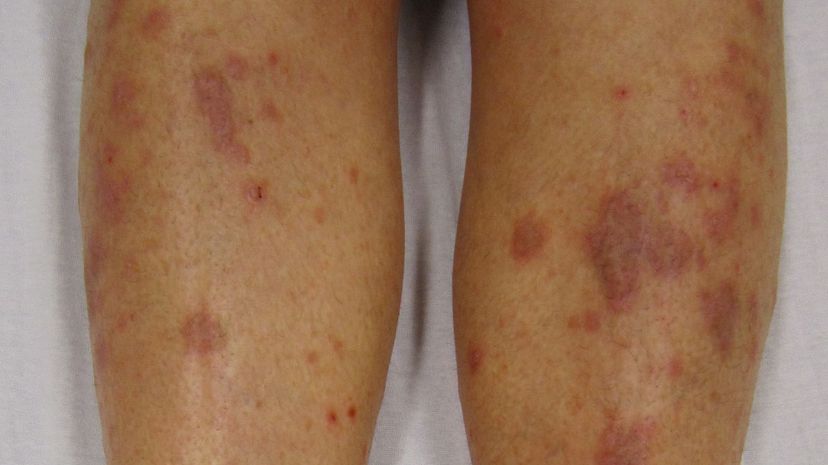 Question 36 - Lichen planus