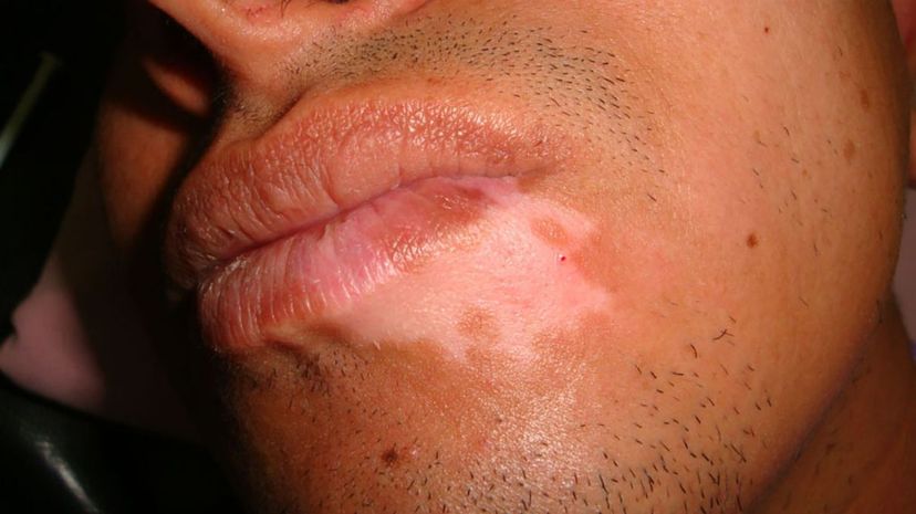 Question 17 - Vitiligo