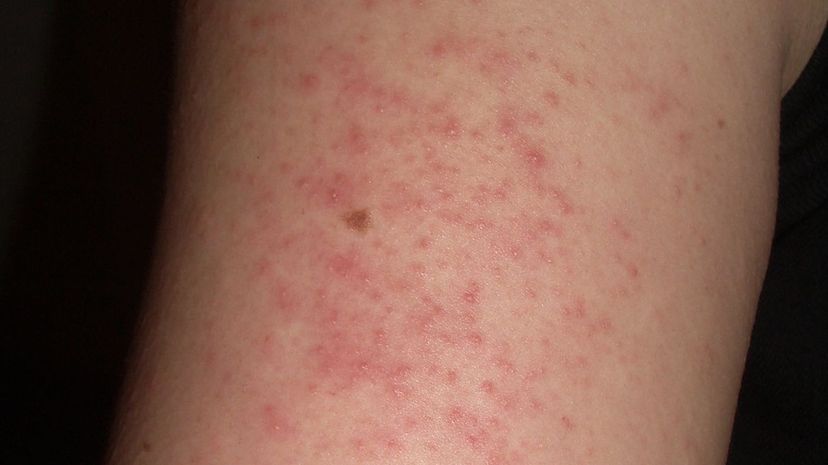 Question 26 - Keratosis pilaris