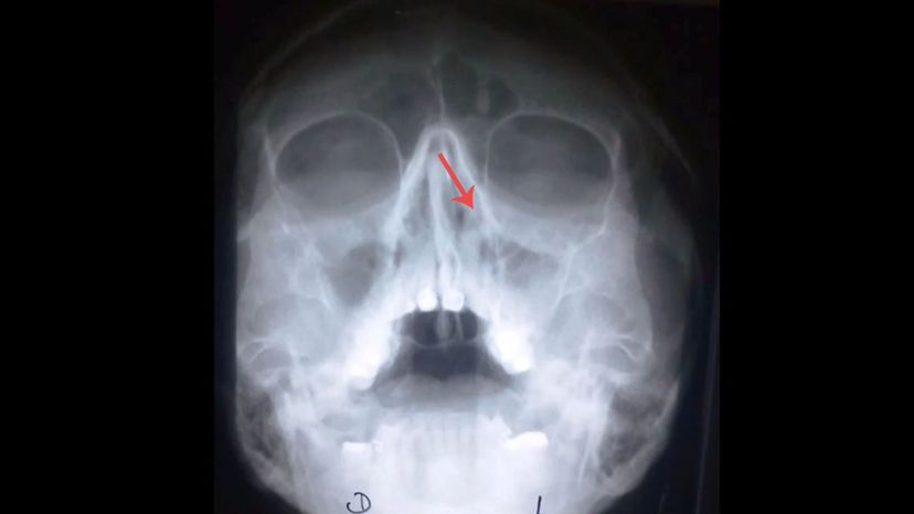 Lacrimal bone