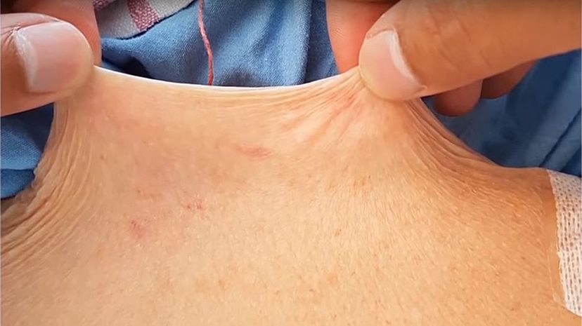 Question 21 - Elastoderma