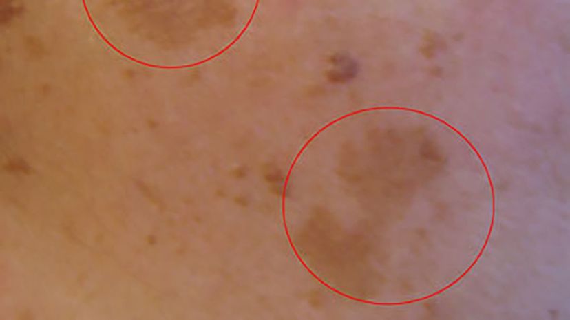 Question 12 - Melasma