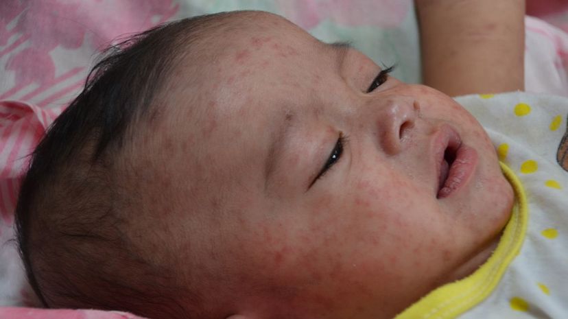 Question 3 - Measles