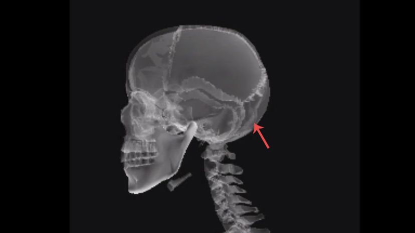 Occipital bone