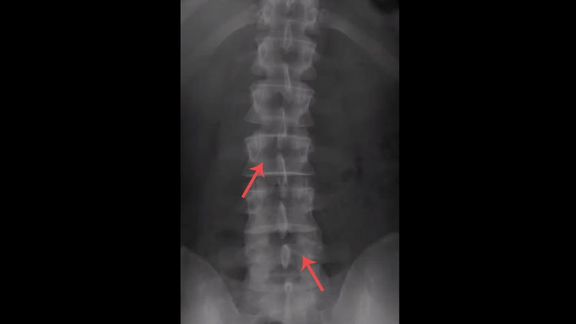 Lumbar vertibrae