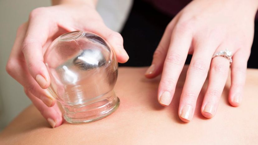 33 erotic cupping