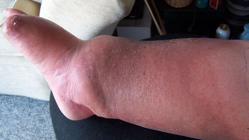 Question 16 - Cellulitis