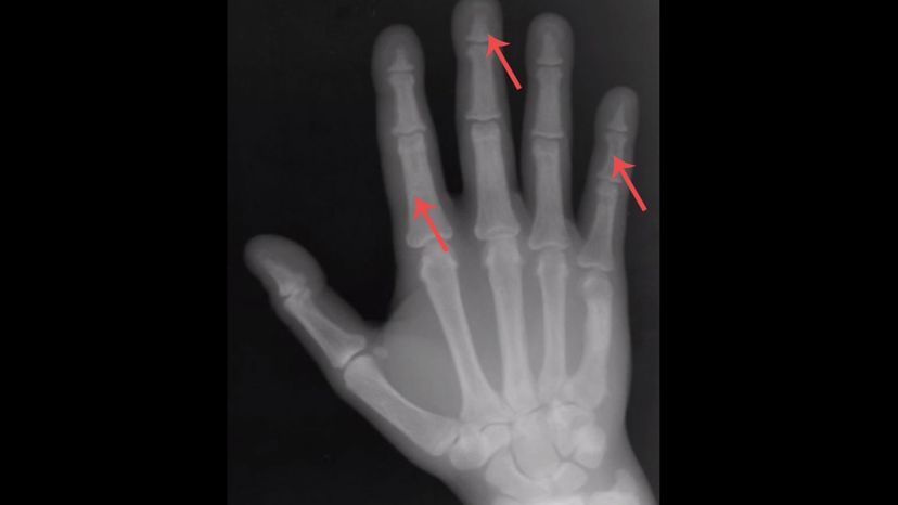 Phalanges of the hand