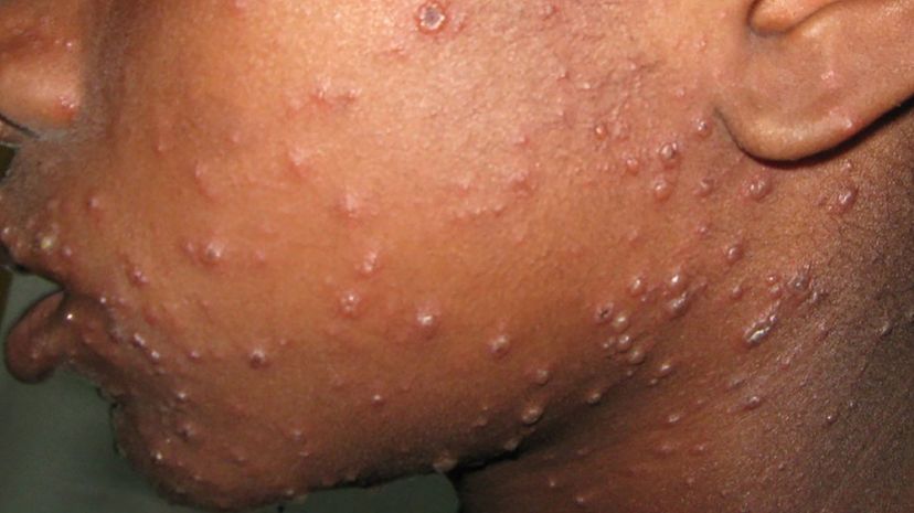 Question 4 - Chickenpox