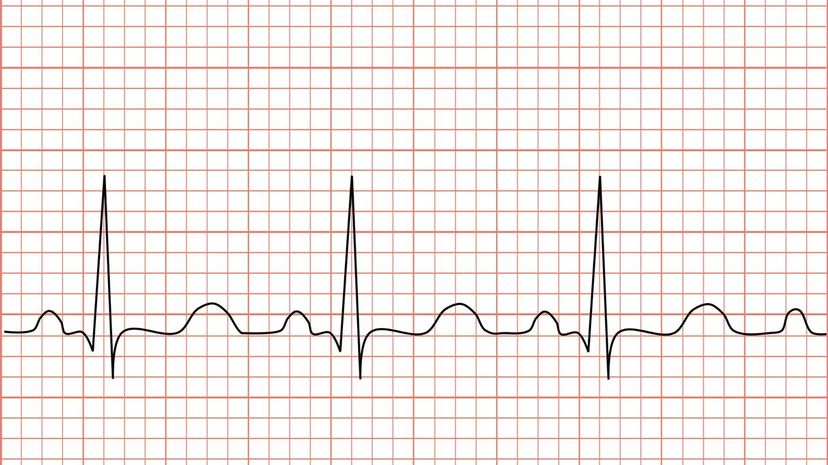 Tachycardia_ECG_paper”border=