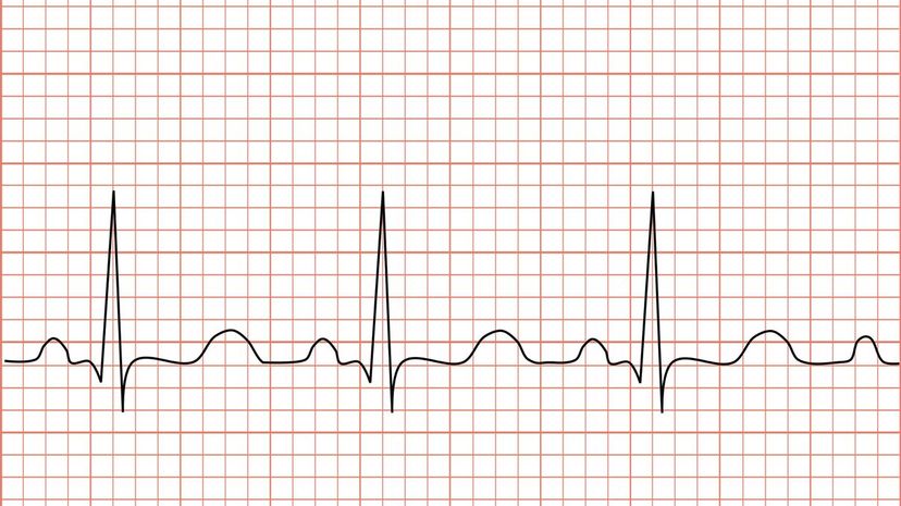 Tachycardia_ECG_paper