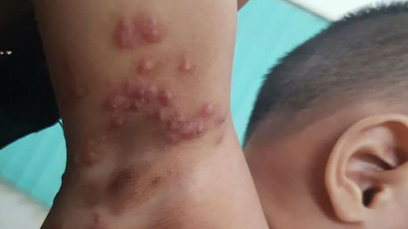 Question 34 - Scabies