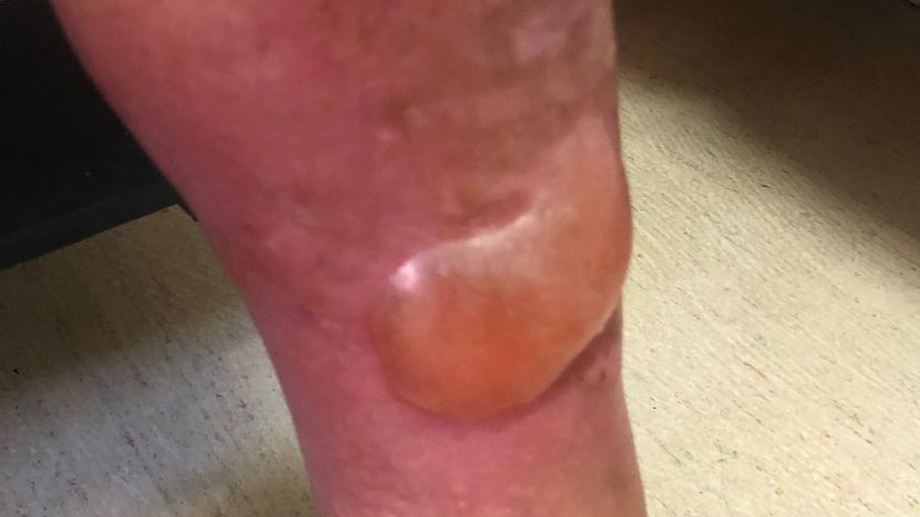 Question 40 - Blister