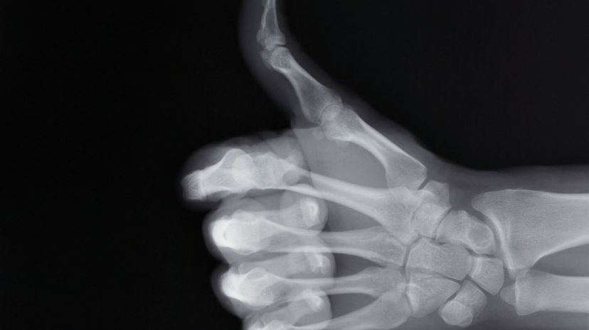 X-ray thumbs up