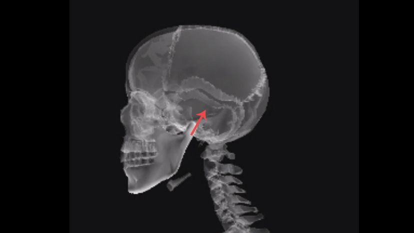 Temporal bone