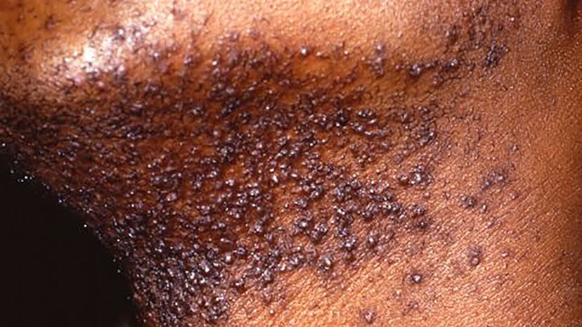 Question 20 - Razor bumps