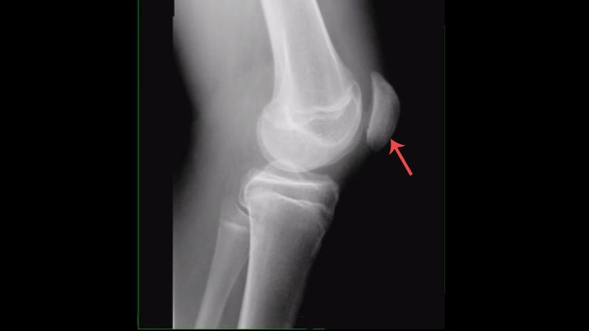 Patella