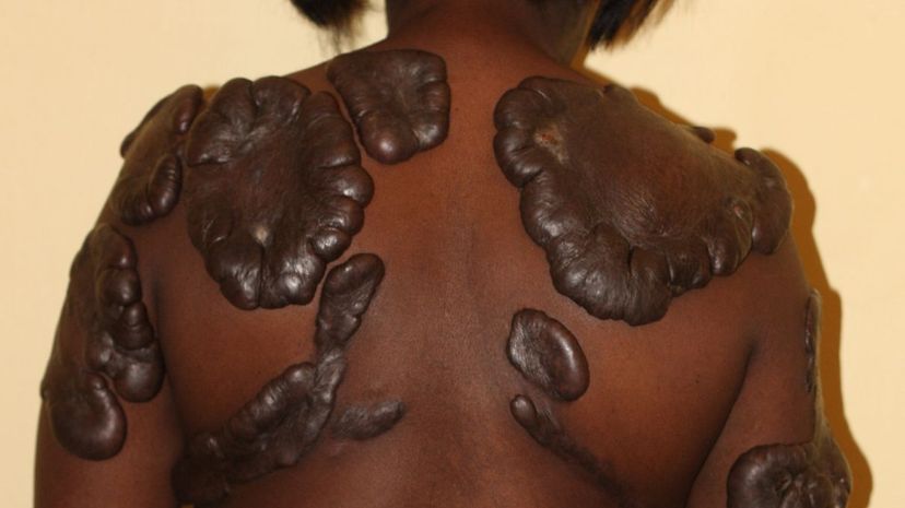 Question 39 - Keloids