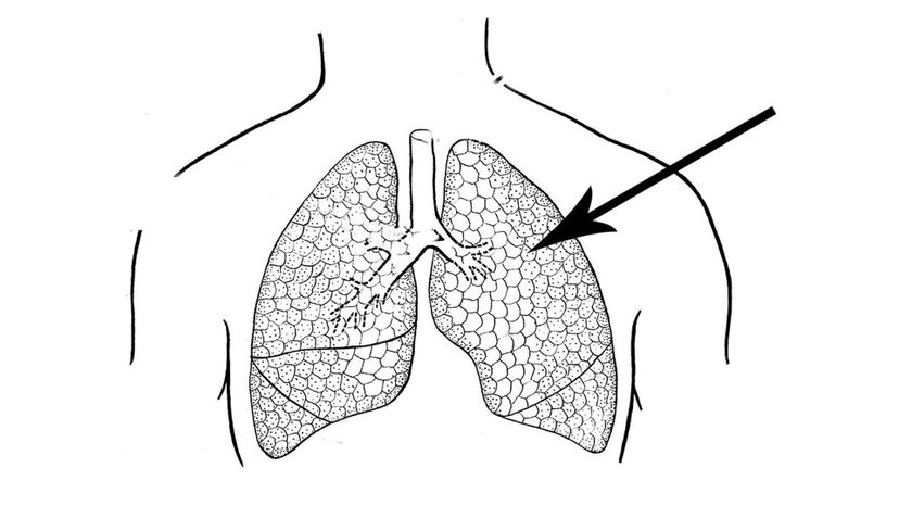 Lungs